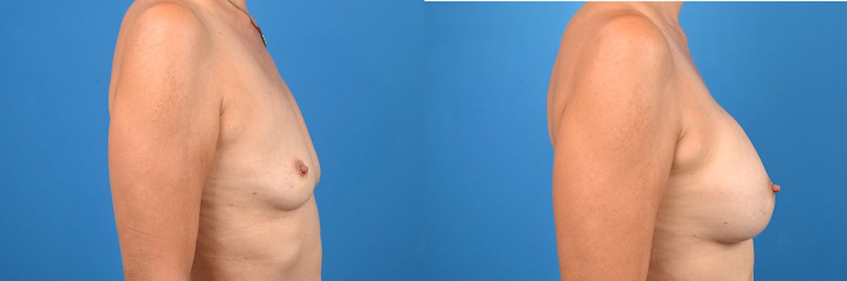 Breast Augmentation Before & After Gallery - Patient 198413 - Image 3