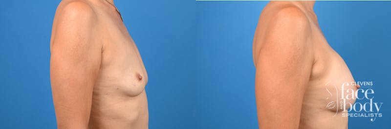 Hidden Breast Aug Before & After Gallery - Patient 324104 - Image 3