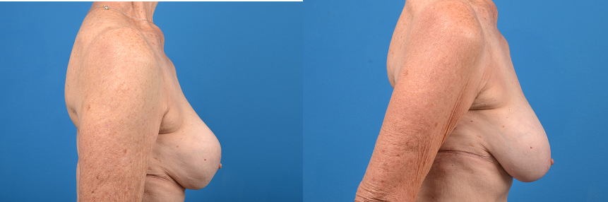 Hidden Breast Implant Exchange Before & After Gallery - Patient 123325 - Image 3