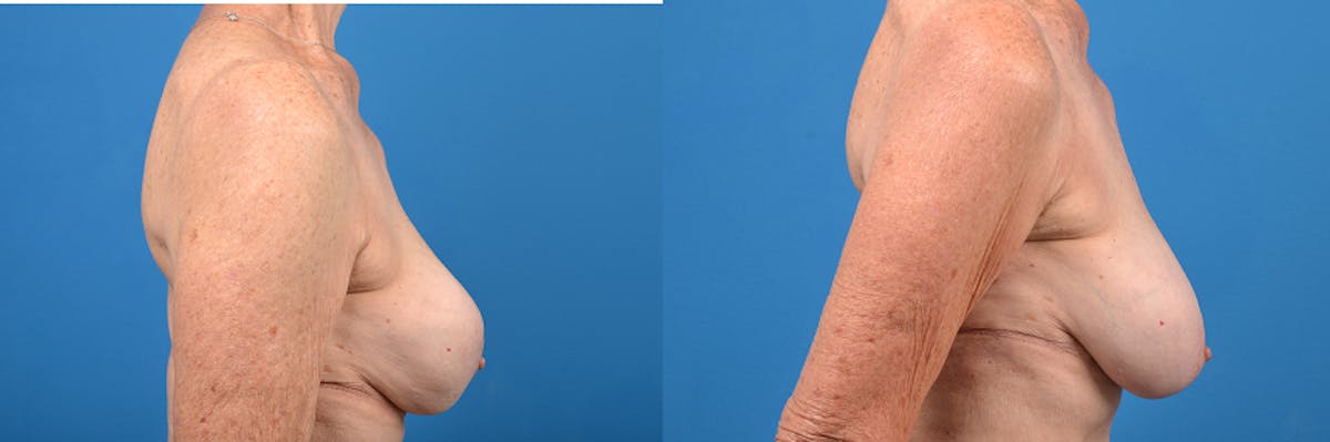 Breast Implant Exchange Before & After Gallery - Patient 905369 - Image 3