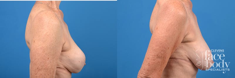 Hidden Breast Implant Exchange Before & After Gallery - Patient 122405410 - Image 3