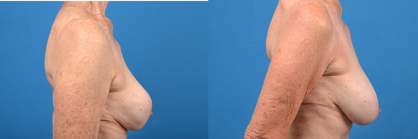 Breast Implant Exchange Before & After Gallery - Patient 122405410 - Image 3