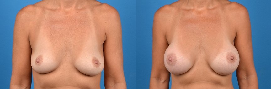 Hidden Breast Aug Before & After Gallery - Patient 414926 - Image 1