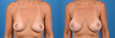 Breast Augmentation Before & After Gallery - Patient 122405411 - Image 1