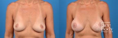 Hidden Breast Aug Before & After Gallery - Patient 273676 - Image 1