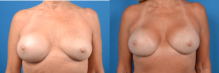 Hidden Breast Implant Exchange Before & After Gallery - Patient 136102 - Image 1