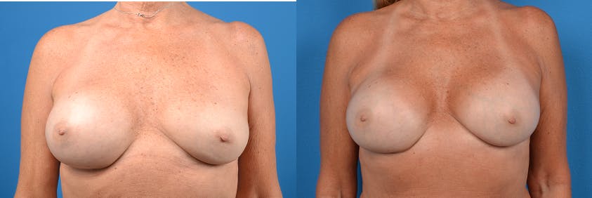 Breast Implant Exchange Before & After Gallery - Patient 122405412 - Image 1