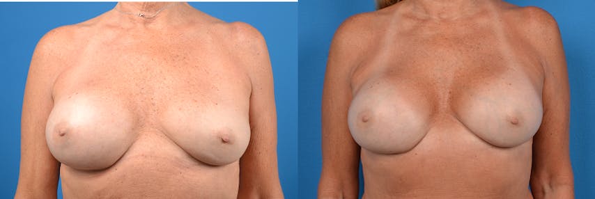 Breast Implant Exchange