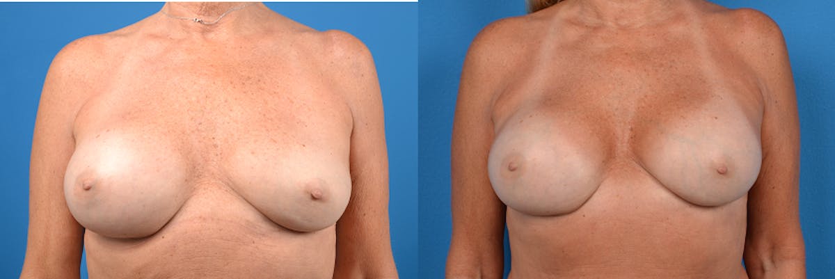 Breast Implant Exchange Before & After Gallery - Patient 122405412 - Image 1