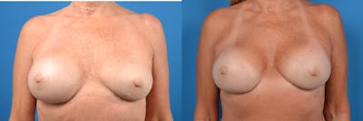 Breast Implant Exchange Before & After Gallery - Patient 122405412 - Image 1