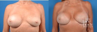 Hidden Breast Implant Exchange Before & After Gallery - Patient 136102 - Image 1