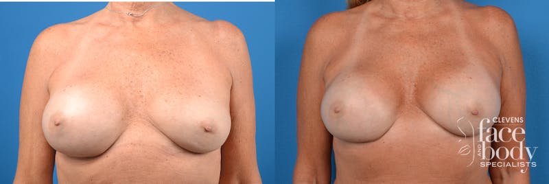 Hidden Breast Implant Exchange Before & After Gallery - Patient 136102 - Image 1