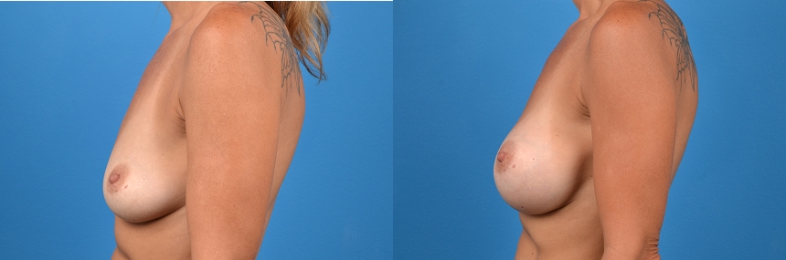 Hidden Breast Aug Before & After Gallery - Patient 414926 - Image 2