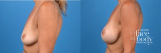 Hidden Breast Aug Before & After Gallery - Patient 414926 - Image 2