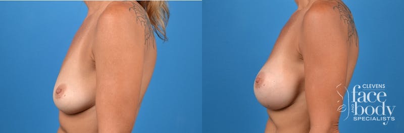 Hidden Breast Aug Before & After Gallery - Patient 414926 - Image 2