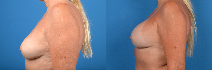 Hidden Breast Implant Exchange Before & After Gallery - Patient 136102 - Image 2
