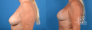 Hidden Breast Implant Exchange Before & After Gallery - Patient 136102 - Image 2