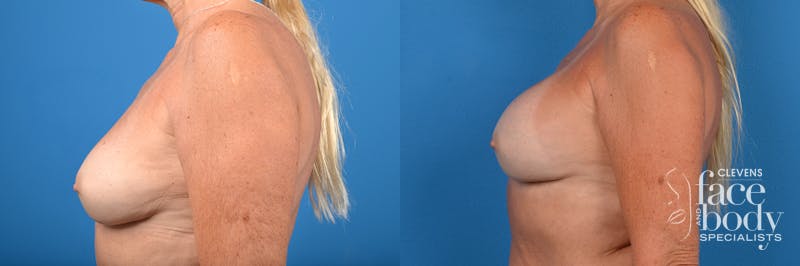 Hidden Breast Implant Exchange Before & After Gallery - Patient 136102 - Image 2