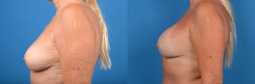 Breast Implant Exchange Before & After Gallery - Patient 122405412 - Image 2