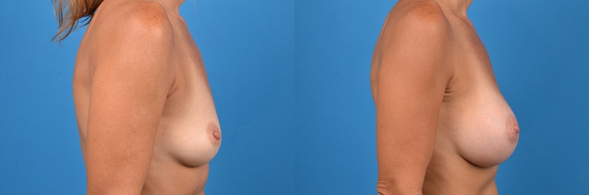 Hidden Breast Aug Before & After Gallery - Patient 414926 - Image 3