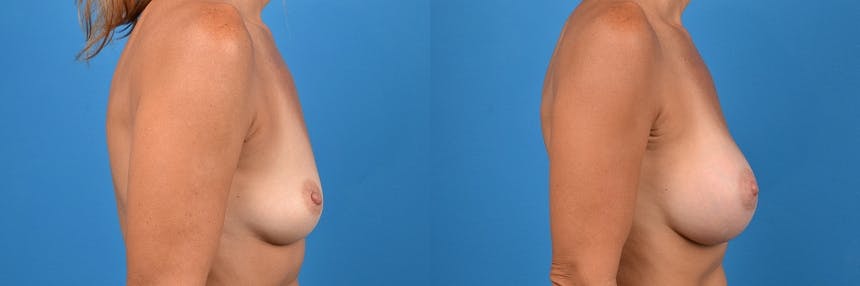 Breast Augmentation Before & After Gallery - Patient 122405411 - Image 3
