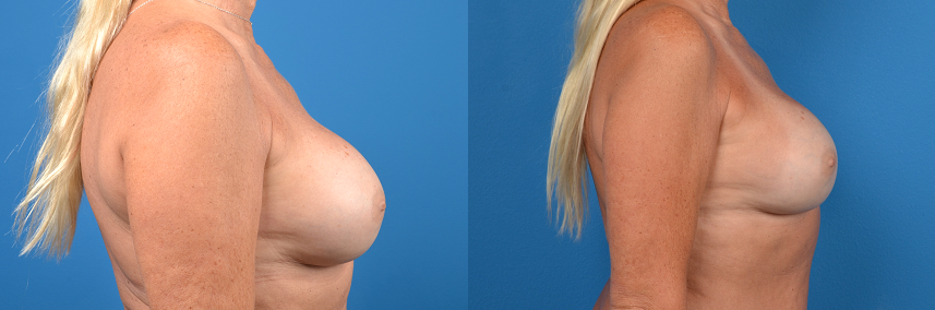Hidden Breast Implant Exchange Before & After Gallery - Patient 136102 - Image 3