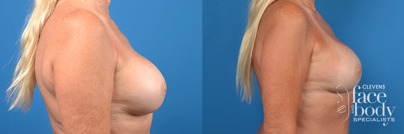 Hidden Breast Implant Exchange Before & After Gallery - Patient 136102 - Image 3
