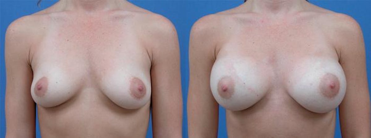 Breast Augmentation Before & After Gallery - Patient 336598 - Image 1