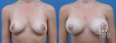 Hidden Breast Aug Before & After Gallery - Patient 123996 - Image 1