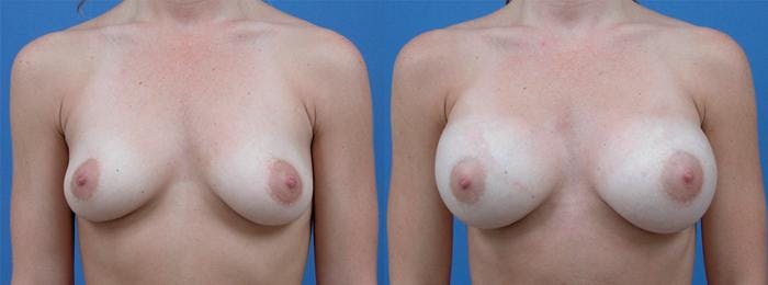 Breast Augmentation Before & After Gallery - Patient 122405413 - Image 1