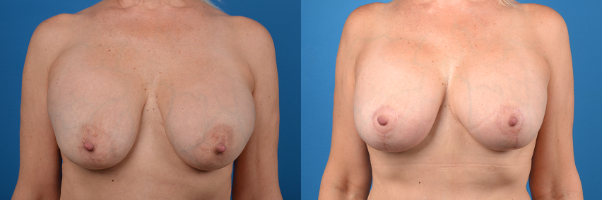 Hidden Breast Implant Exchange Before & After Gallery - Patient 307275 - Image 1