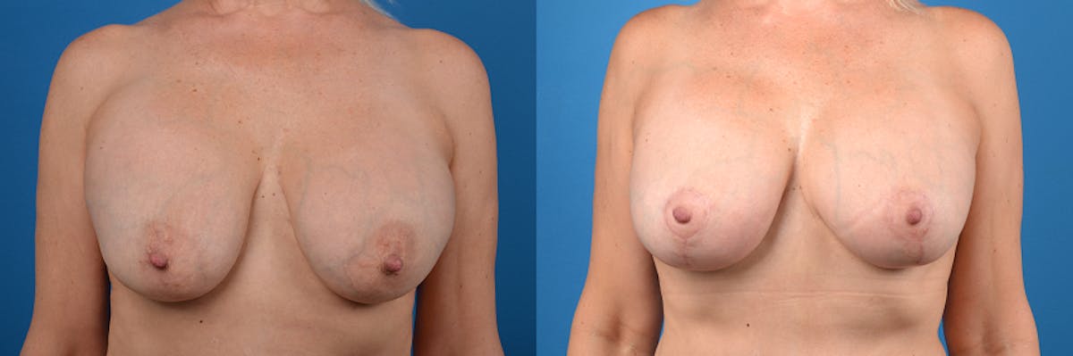 Breast Implant Exchange Before & After Gallery - Patient 413329 - Image 1