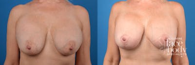 Hidden Breast Implant Exchange Before & After Gallery - Patient 307275 - Image 1