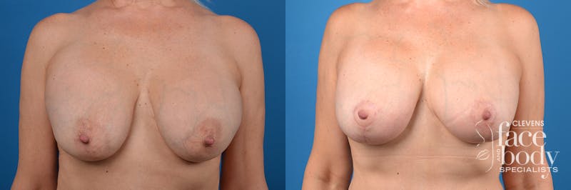 Hidden Breast Implant Exchange Before & After Gallery - Patient 307275 - Image 1