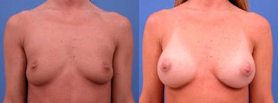 Breast Augmentation Before & After Gallery - Patient 122405414 - Image 1