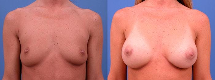 Breast Augmentation Before & After Gallery - Patient 122405414 - Image 1