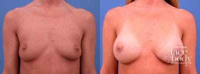 Hidden Breast Aug Before & After Gallery - Patient 235870 - Image 1