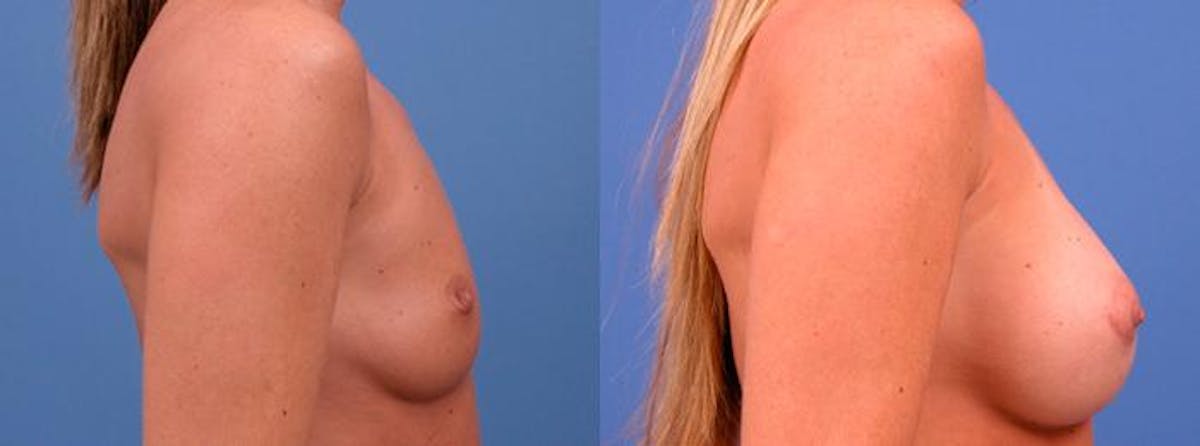 Breast Augmentation Before & After Gallery - Patient 297483 - Image 2