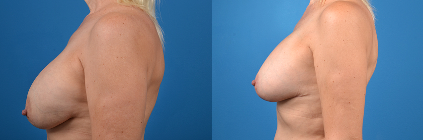 Hidden Breast Implant Exchange Before & After Gallery - Patient 307275 - Image 2