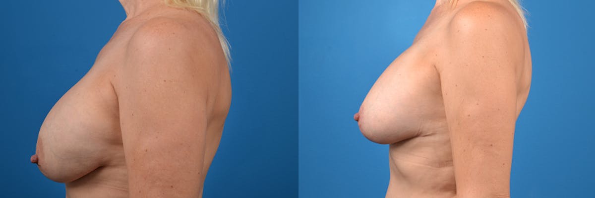 Breast Implant Exchange Before & After Gallery - Patient 413329 - Image 2
