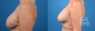 Hidden Breast Implant Exchange Before & After Gallery - Patient 307275 - Image 2