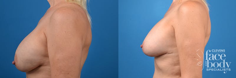 Hidden Breast Implant Exchange Before & After Gallery - Patient 307275 - Image 2