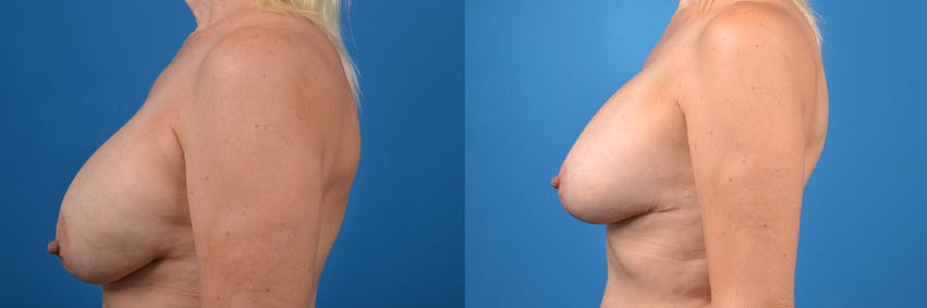 Breast Implant Exchange Before & After Gallery - Patient 122405415 - Image 2