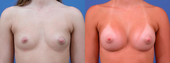 Hidden Breast Aug Before & After Gallery - Patient 365921 - Image 1