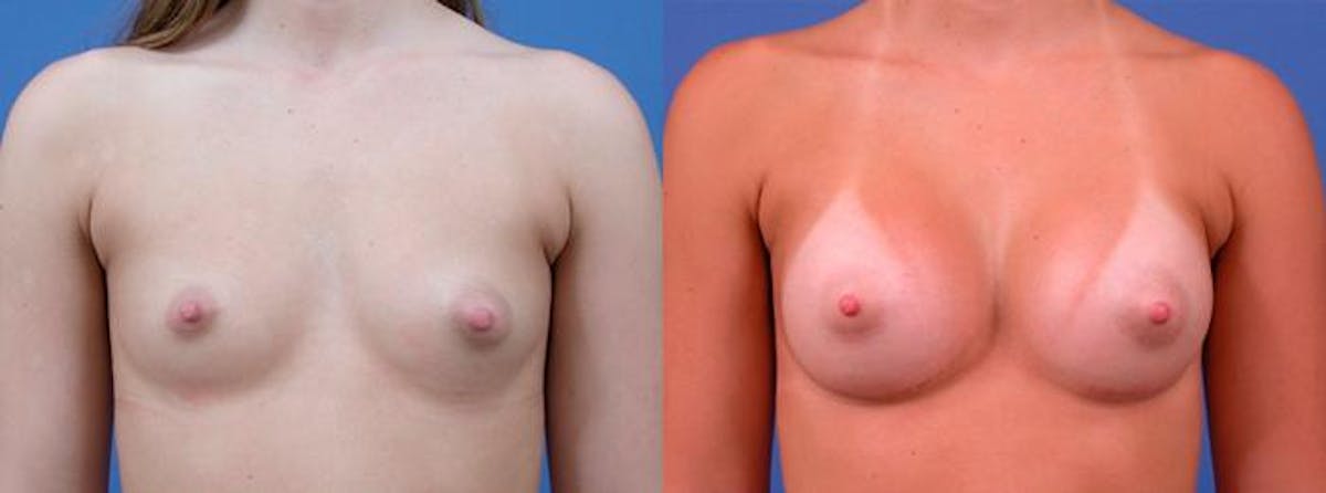 Breast Augmentation Before & After Gallery - Patient 842992 - Image 1