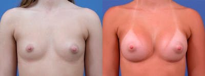 Breast Augmentation Before & After Gallery - Patient 122405416 - Image 1