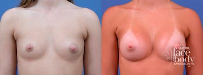 Hidden Breast Aug Before & After Gallery - Patient 365921 - Image 1