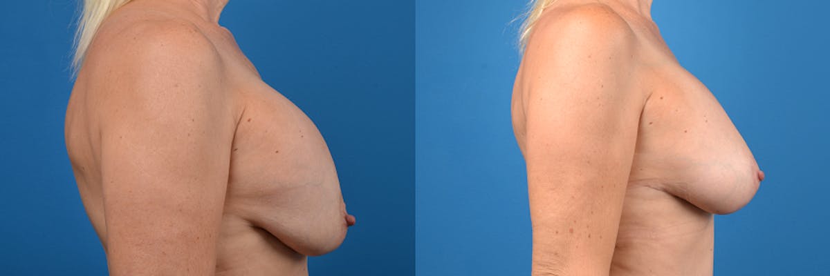 Breast Implant Exchange Before & After Gallery - Patient 413329 - Image 3