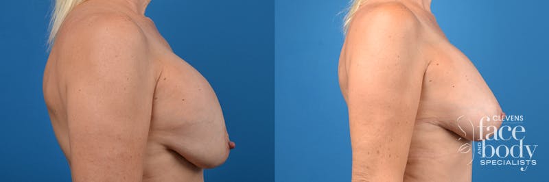Hidden Breast Implant Exchange Before & After Gallery - Patient 307275 - Image 3
