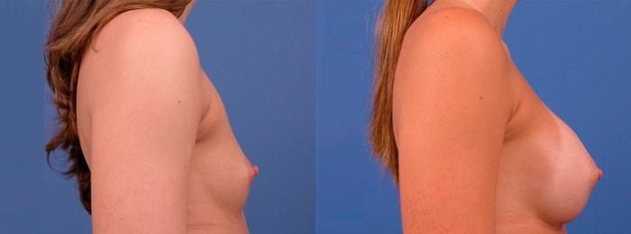 Hidden Breast Aug Before & After Gallery - Patient 365921 - Image 2